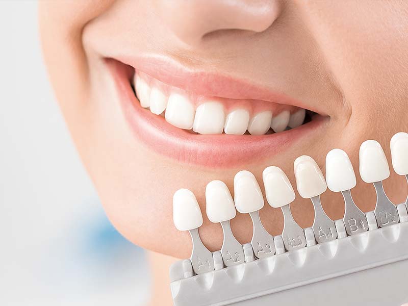 牙齒美白