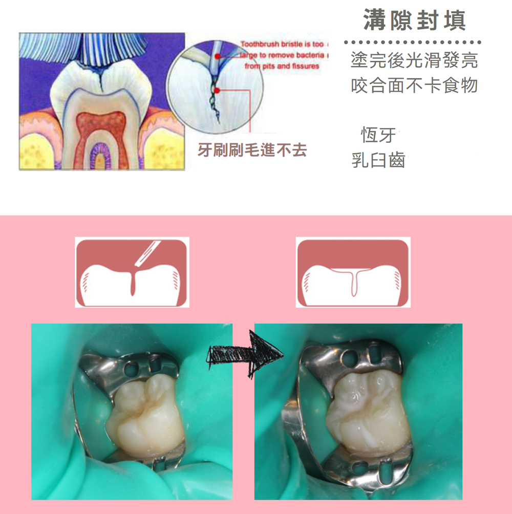 兒童牙科 兒童牙科