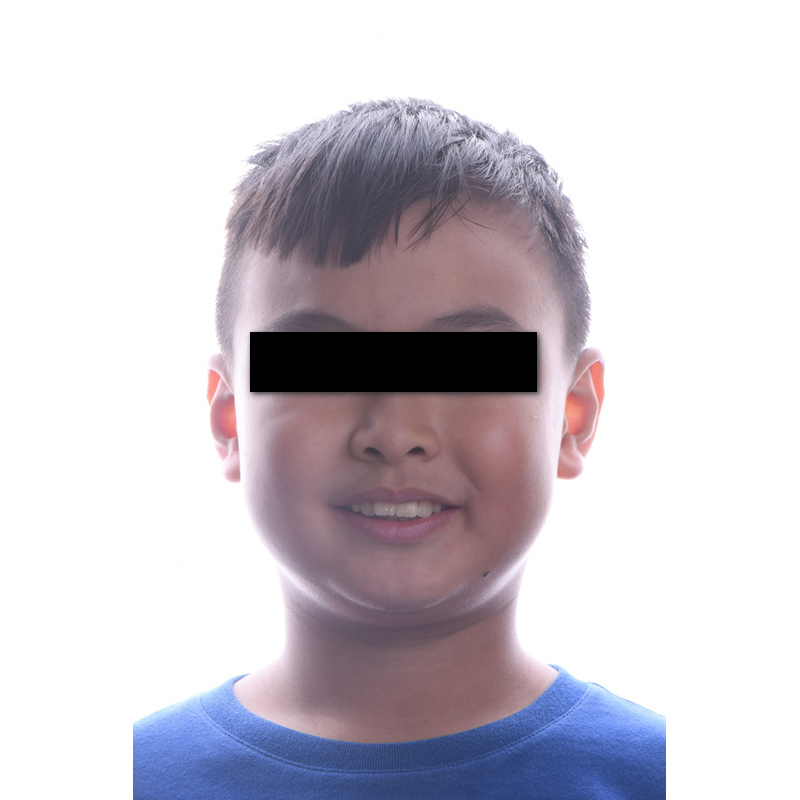 隱適美兒童案例