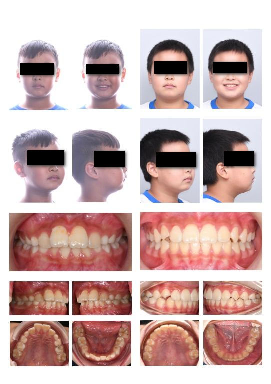 隱適美兒童案例