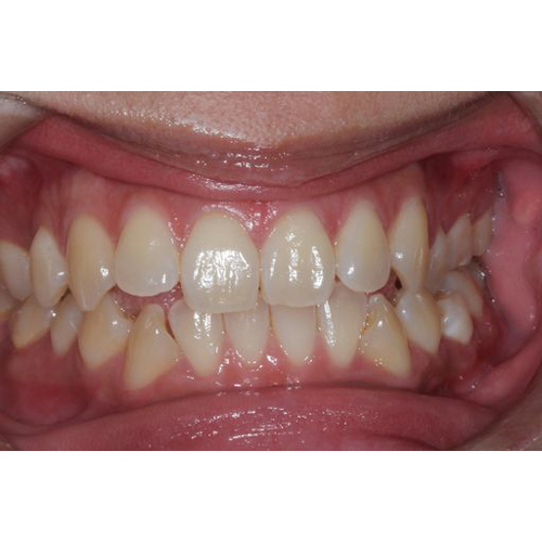 隱適美拔牙案例