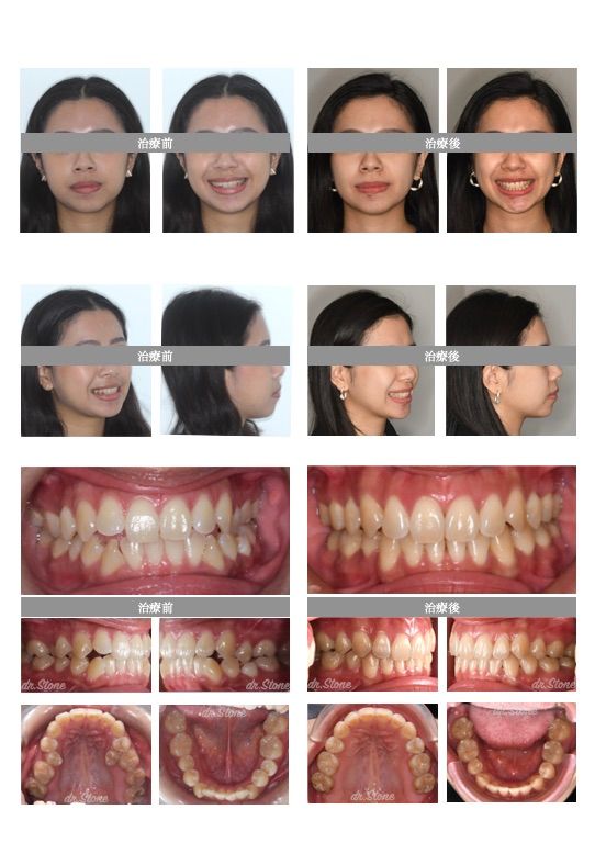 隱適美拔牙案例