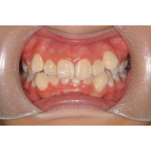 隱適美非拔牙青少年案例