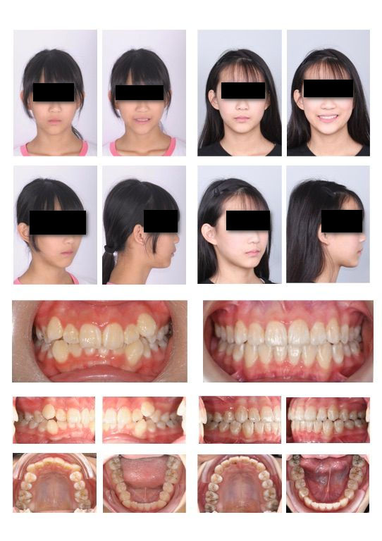 隱適美非拔牙青少年案例