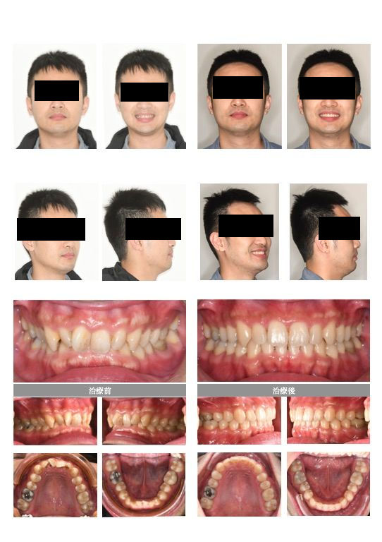 隱適美深咬案例