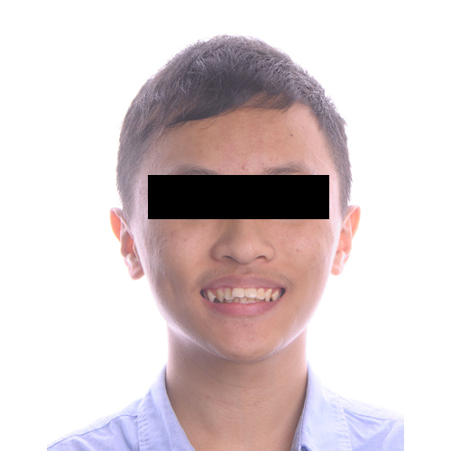 隱適美暴牙案例